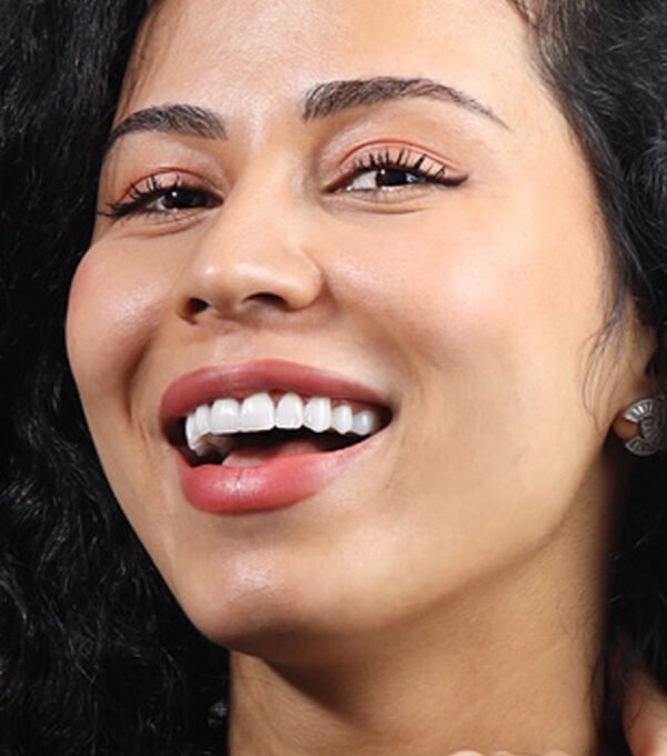 Hollywood Smile
