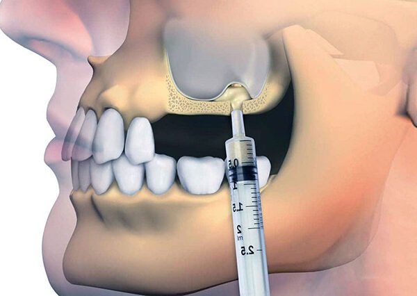 Sinus Lifting