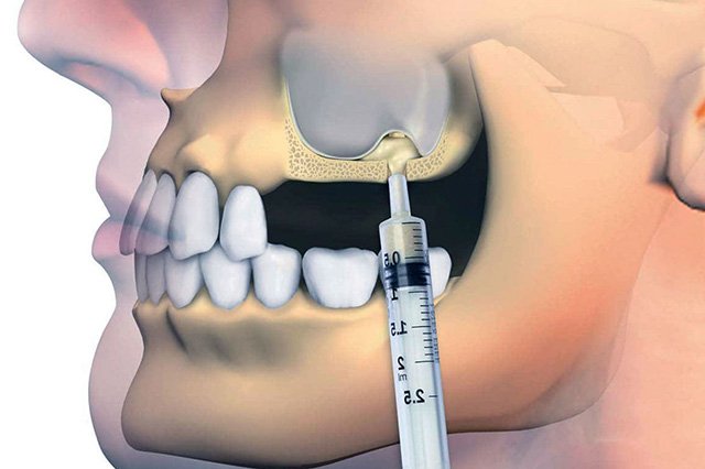 Sinus Lifting